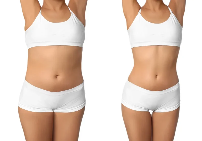 non-invasive body contouring before and after